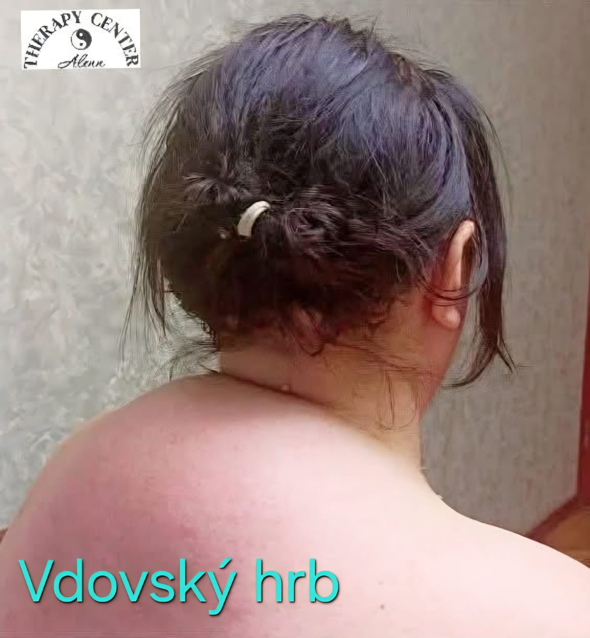 Ukážka oblasti šije pred masážou